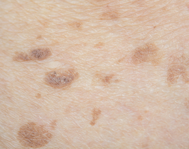 40代の肌トラブルはシミ・シワ・たるみ・毛穴！その症状と原因を解説