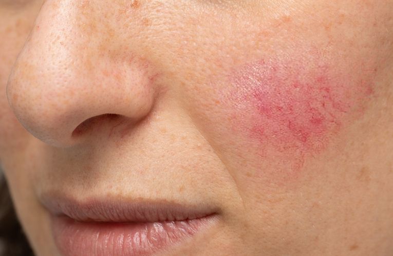 オリーブスクワランの効果・効能⑦肌の赤みや傷跡を癒す